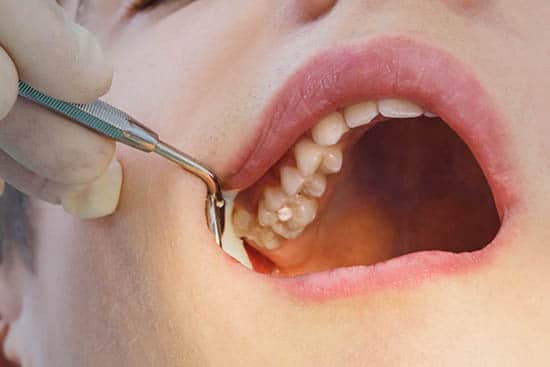 dental fillings and cavities for patient