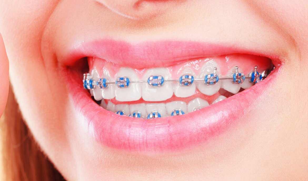 traditional braces smile