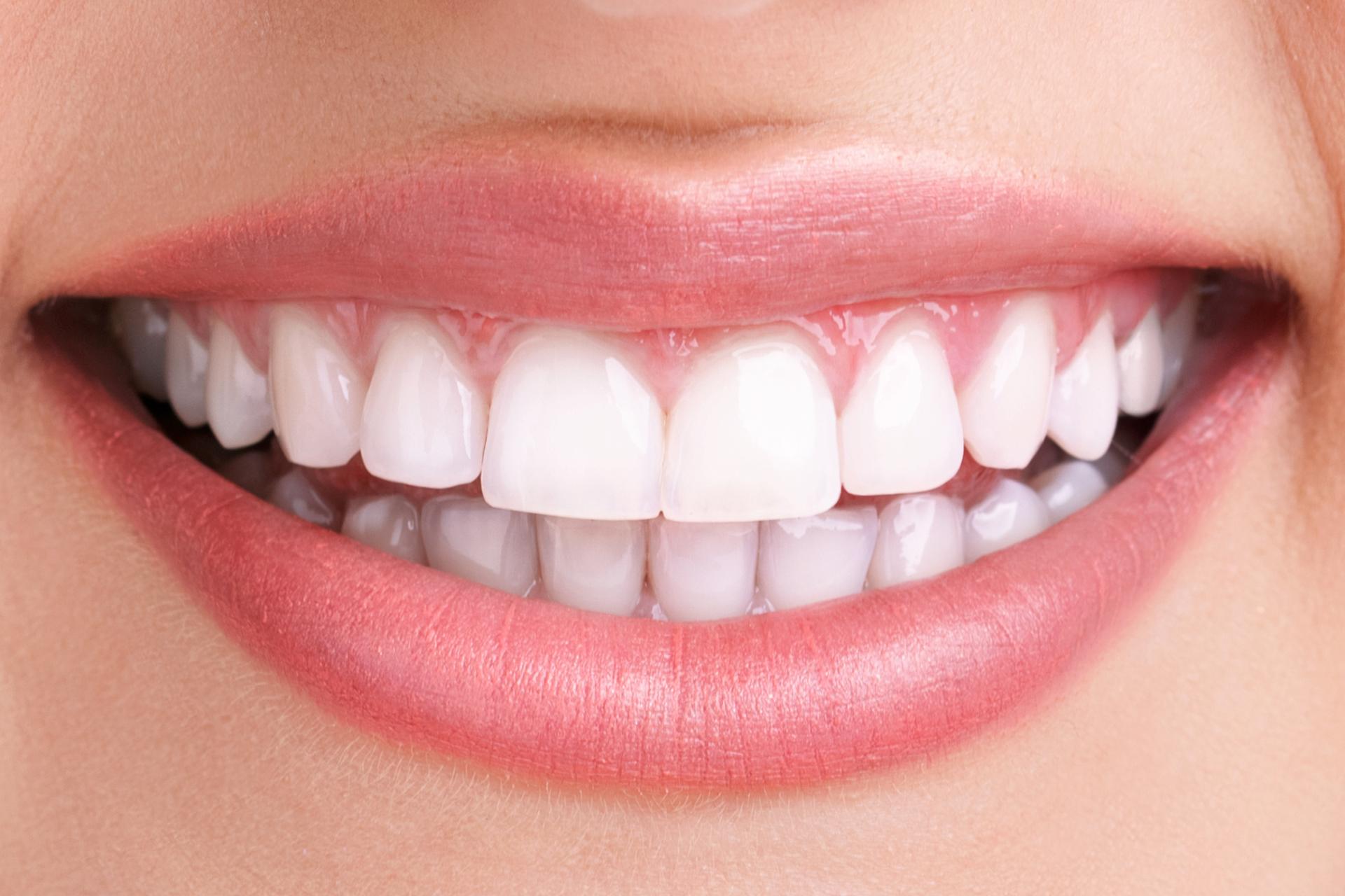 white teeth after teeth whitening dental care
