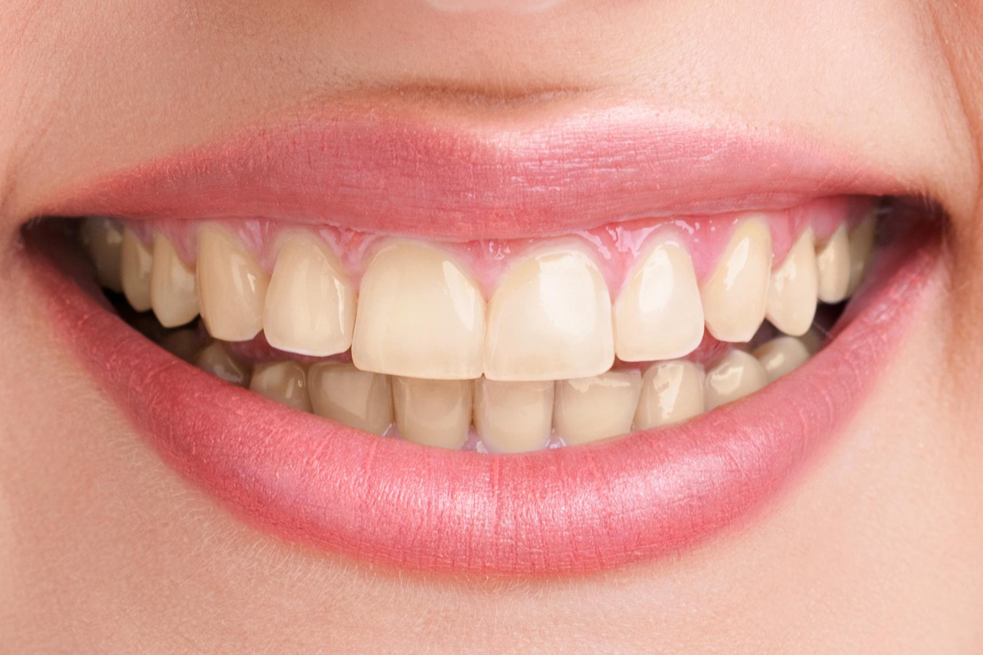 yellow teeth needing teeth whitening dental care